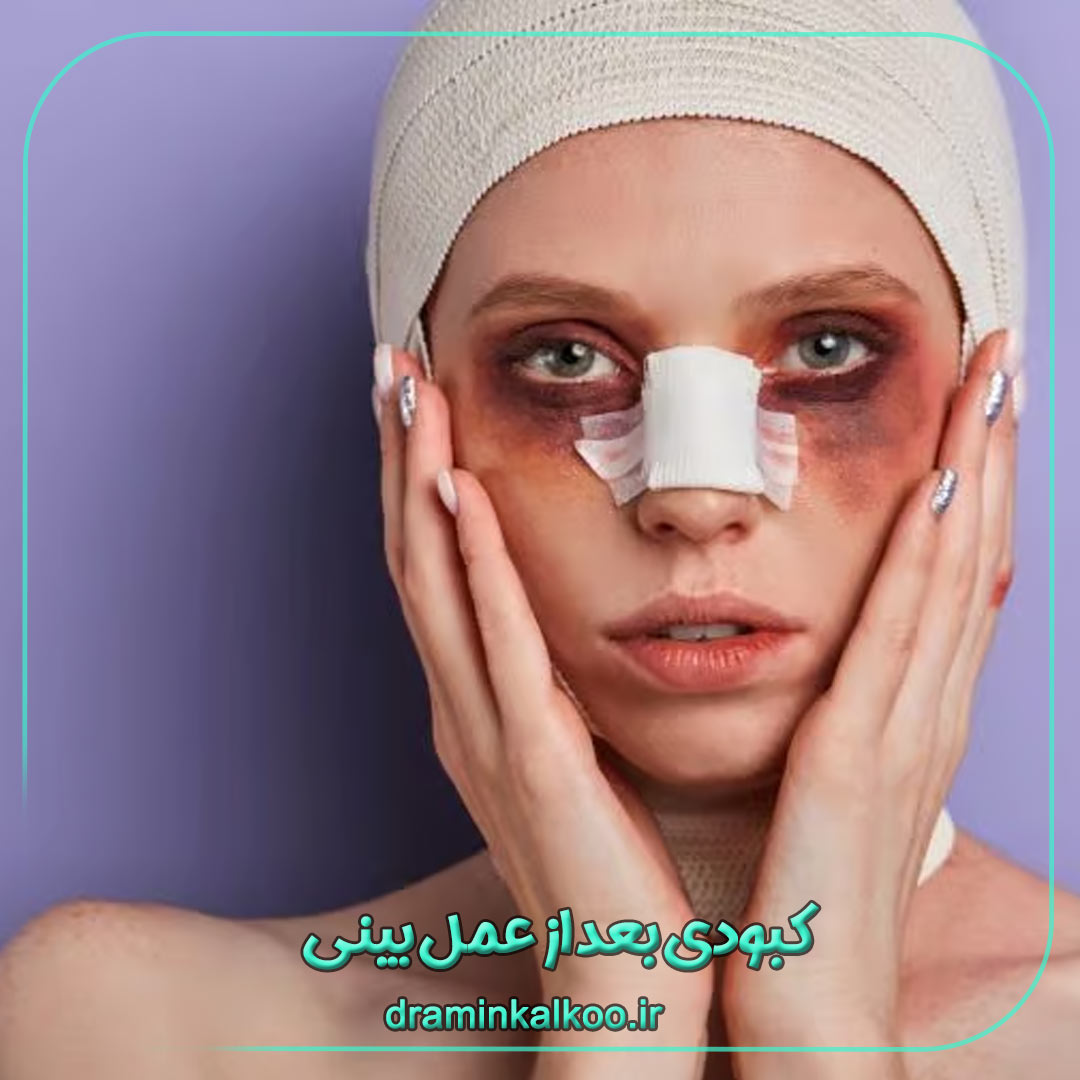کبودی بعد از عمل بینی